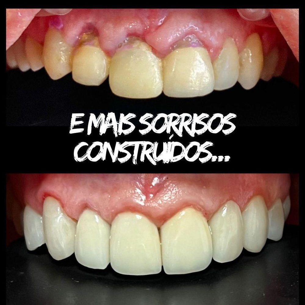 Antes e depois de um tratamento na COP