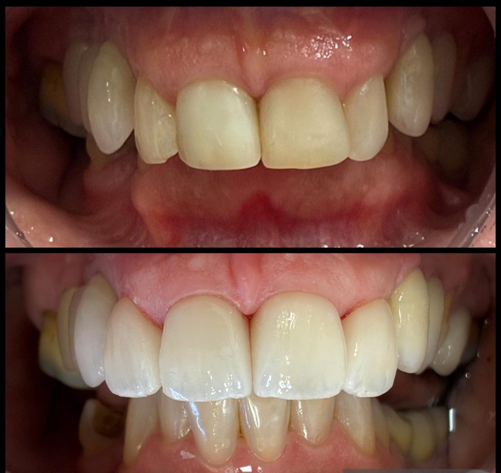 Antes e depois de um tratamento na COP
