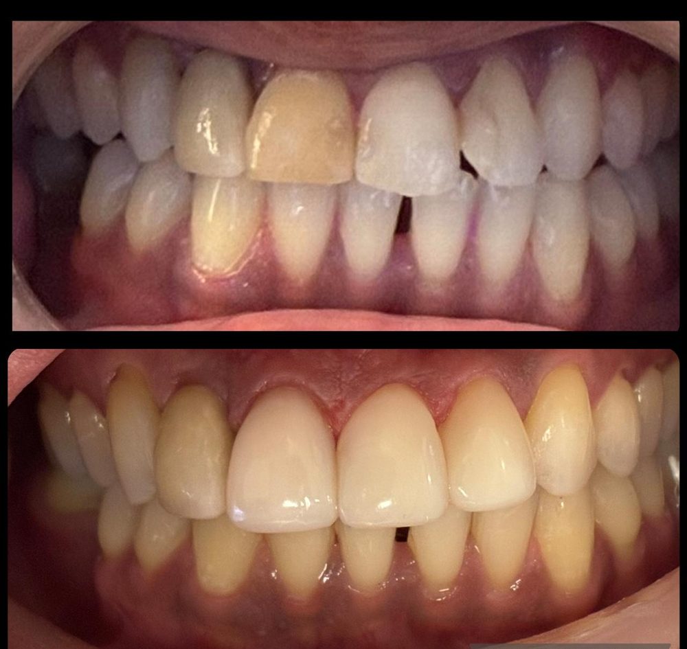 Antes e depois de um tratamento na COP