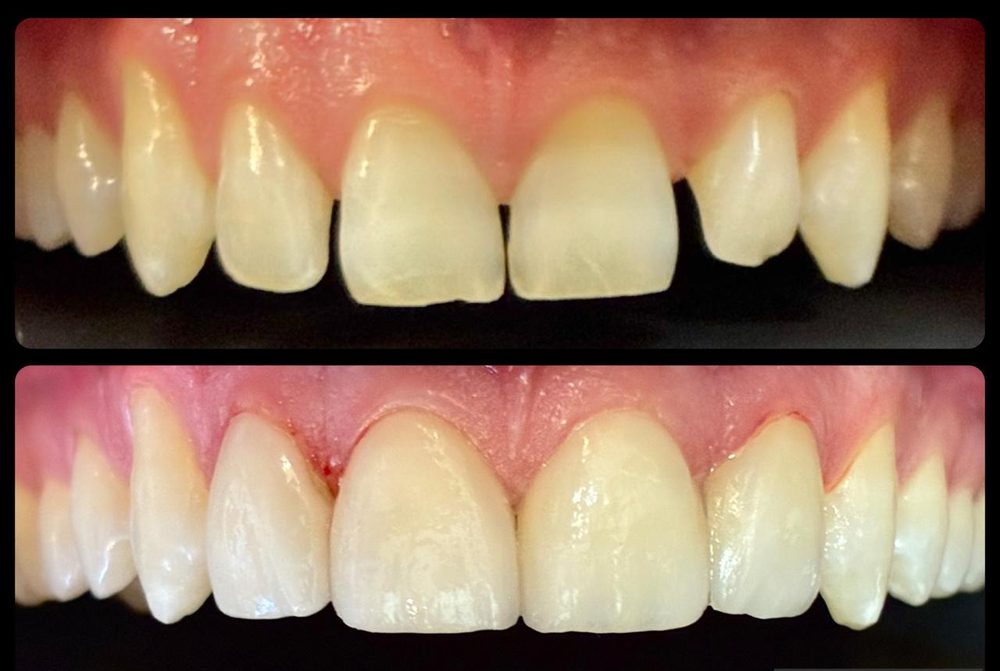 Antes e depois de um tratamento na COP